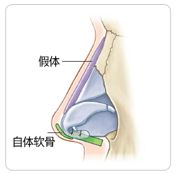 隆鼻权威医生-让你告别塌鼻子